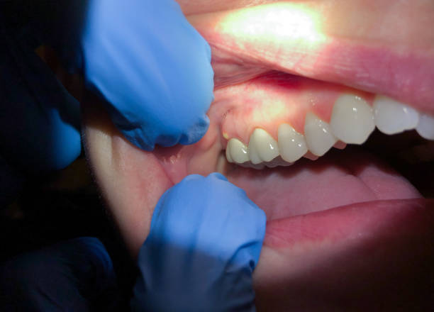 Best Emergency Wisdom Teeth Removal in Vidalia, GA